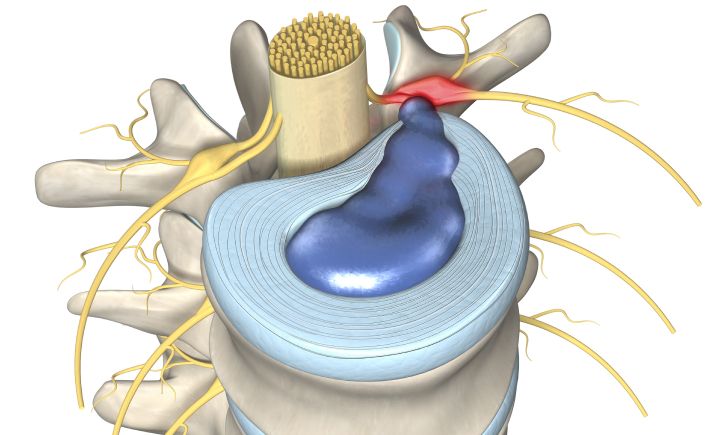 Medical illustration of a Herniated Disc (Slipped Disc)