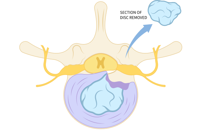 Medical illustration of a Laminectomy Procedure
