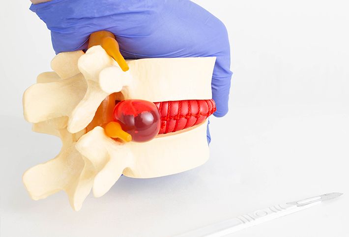 Medical illustration of a Microdiscectomy Procedure