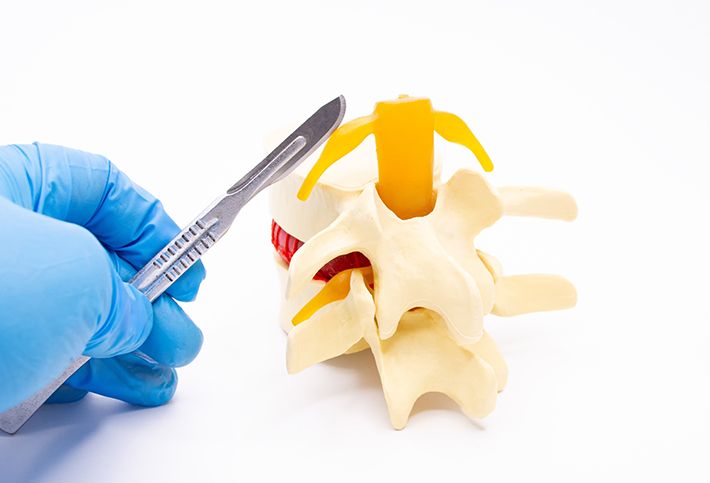 Doctor explaining spinal decompression surgery, also known as decompressive laminectomy