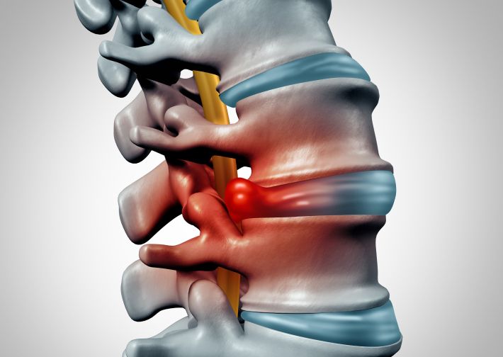 What are the Risk Factors of a Herniated Disc?